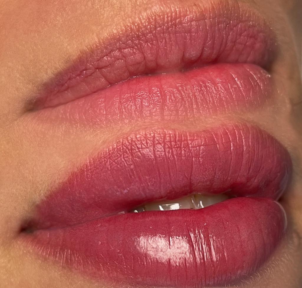 Time4Me_Düren_Hyaluron-Filler